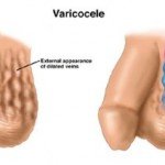 varicocele treatment